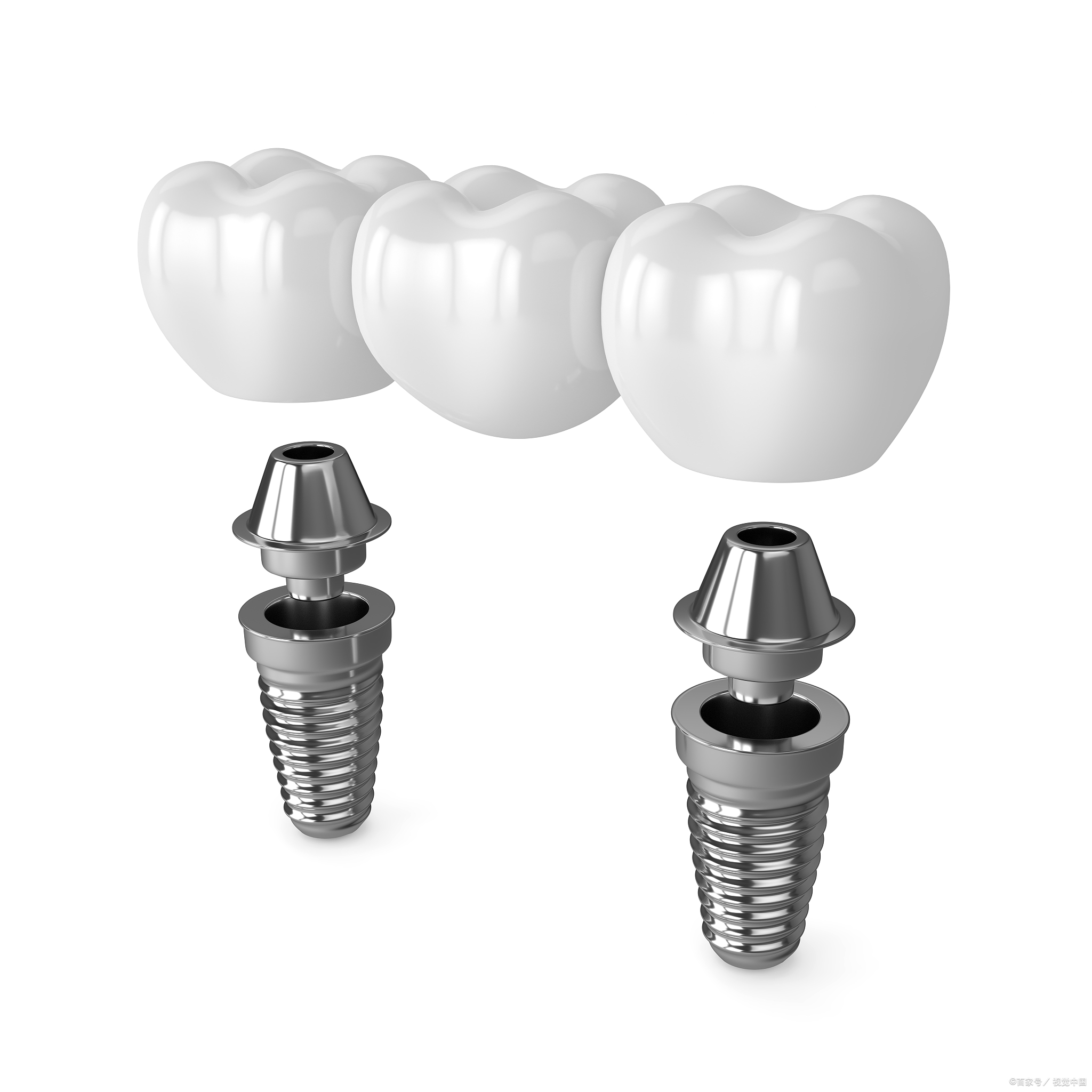 Titanium Alloy Implant Analog