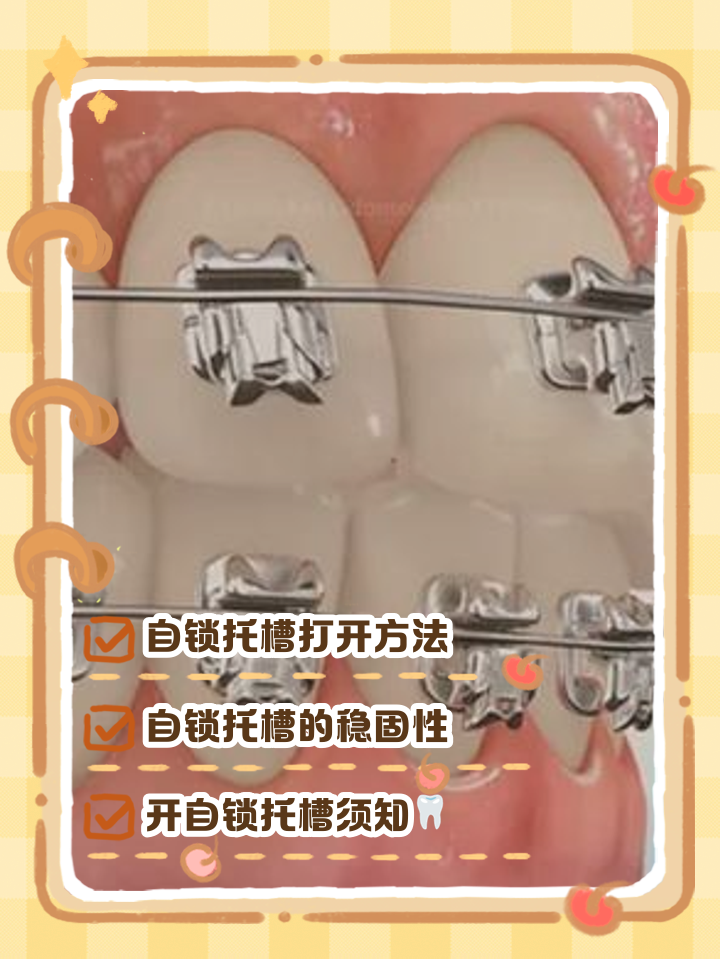 自锁正畸托槽