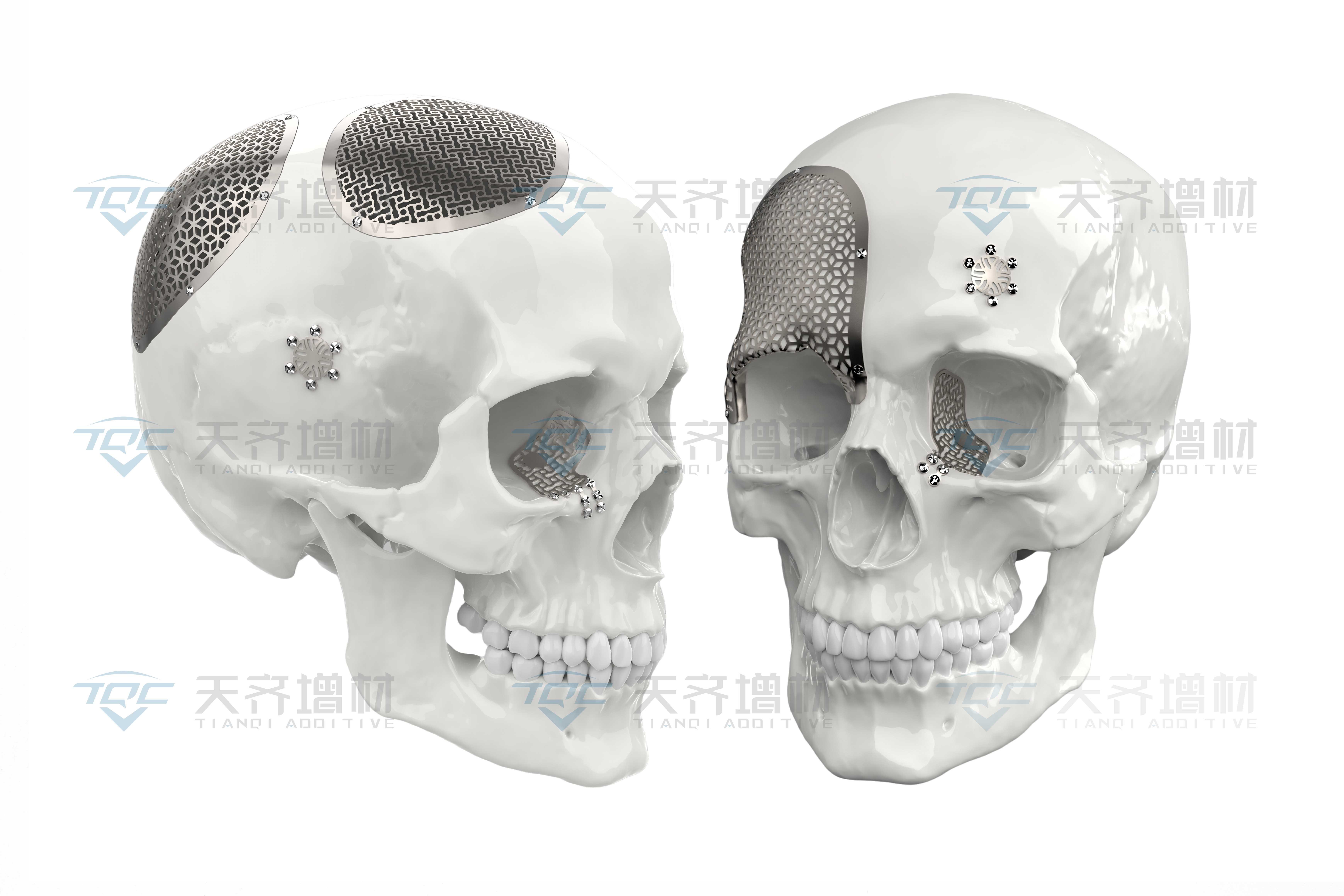 3D Printed Patient-Matched Titanium Cranial Mesh