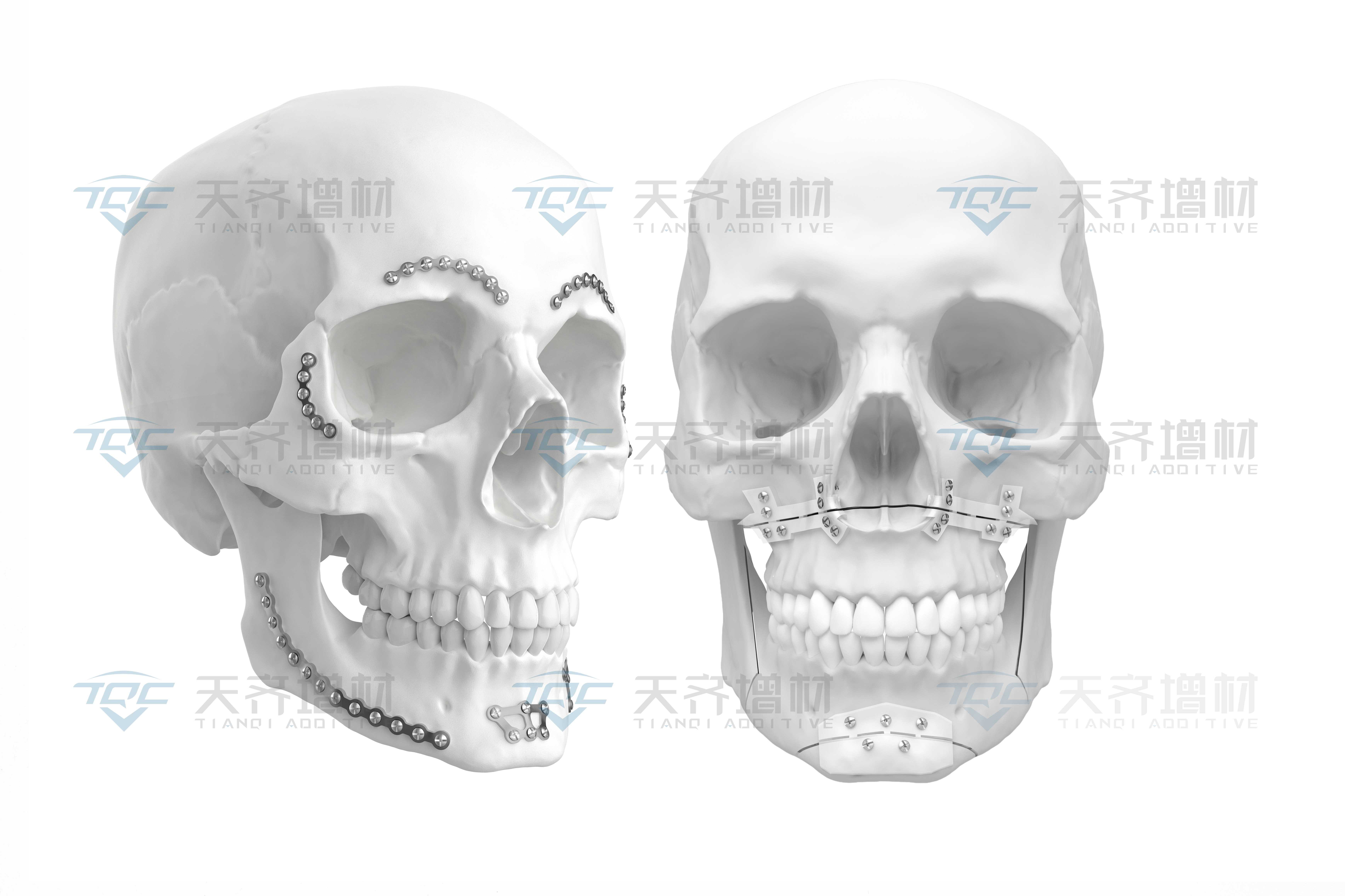 Custom-made Fixed Dental Prosthesis