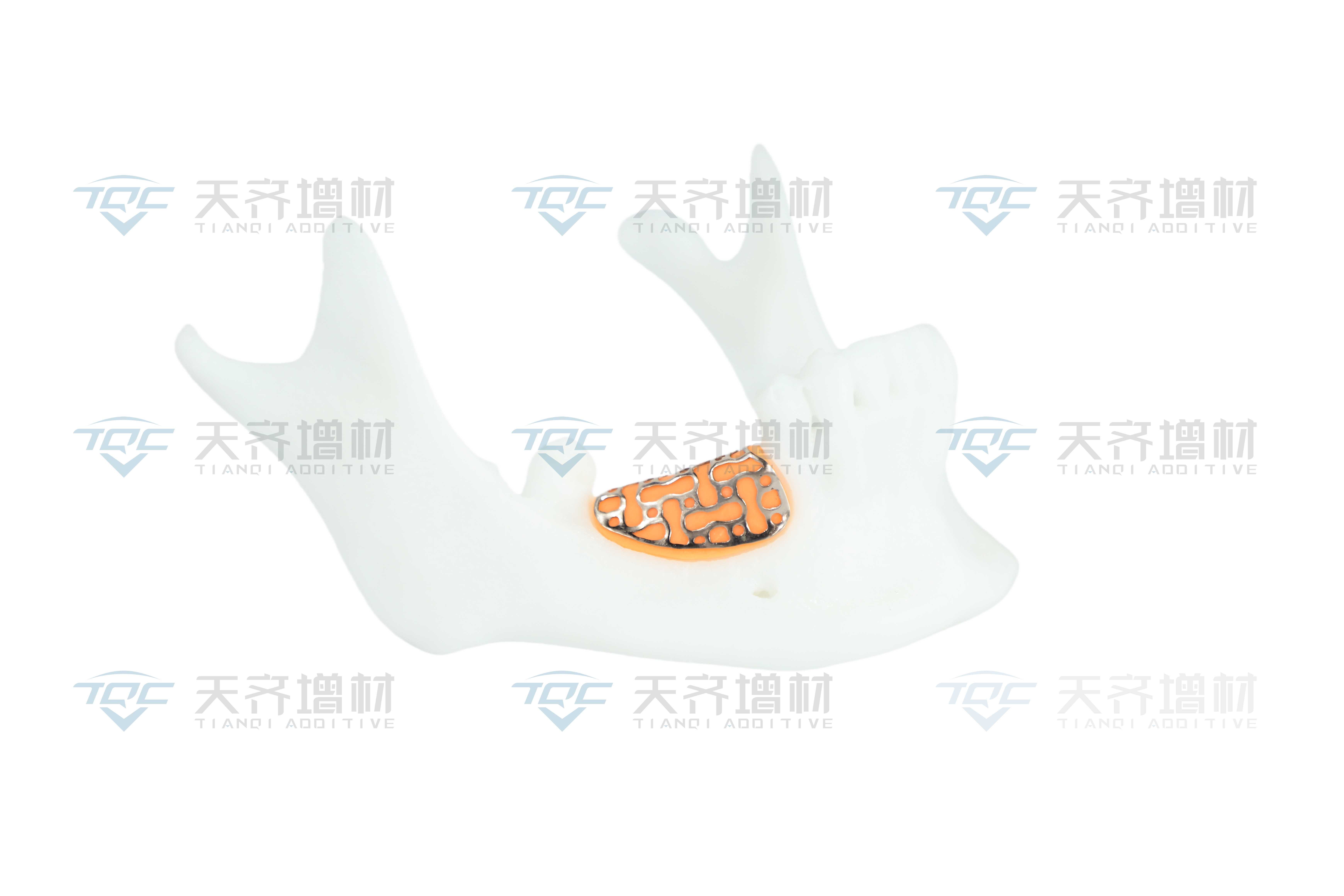 Patient-Matching Maxillofacial Bone Plate, 3D-Printed Titanium